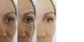 Woman adult face wrinkles effect aging difference after result procedure lifting regeneration orrection treatment