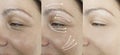 Woman adult face wrinkles effect aging after result procedure lifting regeneration orrection treatment