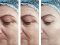 Woman skin wrinkles removal medicine before regeneration difference after collage cosmetology regeneration contrast Royalty Free Stock Photo