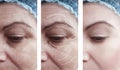 Woman skin wrinkles removal before difference after collage cosmetology regeneration treatments contrast Royalty Free Stock Photo