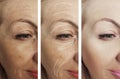 Woman adult skin wrinkles removal before after collage cosmetology regeneration treatments contrast Royalty Free Stock Photo