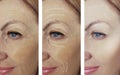 Woman adult skin wrinkles removal lifting beautician before after collage cosmetology regeneration treatments Royalty Free Stock Photo