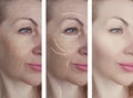Woman adult skin wrinkles removal lifting health before after collage cosmetology regeneration treatments Royalty Free Stock Photo