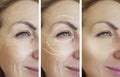 Woman wrinkles removal lifting tightening regeneration difference after collage cosmetology regeneration contrast Royalty Free Stock Photo