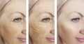 Woman adult wrinkles removal lifting before after collage cosmetology regeneration treatments Royalty Free Stock Photo