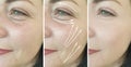Woman adult wrinkles skin after therapy plastic result collagen effect lifting procedure treatment, thread lifting Royalty Free Stock Photo