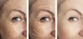 Woman adult wrinkles removal before after collage cosmetology regeneration treatments Royalty Free Stock Photo