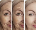 Woman adult wrinkles removal before and after collage cosmetology regeneration treatments Royalty Free Stock Photo