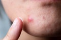 Woman apply cream on the acne.skin with pimple and pore.