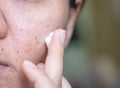 Woman applying cream onto face that has problem problematic skin , acne scars ,oily skin and pore, dark spots and blackhead and Royalty Free Stock Photo