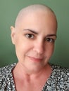 Woman with balding shaved head from chemotherapy for ovarian cancer Royalty Free Stock Photo