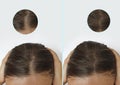 Woman baldness hair before therapy after treatment baldness Royalty Free Stock Photo