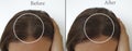 Woman baldness hair thinning  before therapy after treatment baldness Royalty Free Stock Photo
