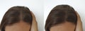 Woman baldness hair before  after treatment baldness Royalty Free Stock Photo