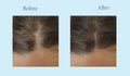 woman baldness hair before and after alopecia treatment therapy Royalty Free Stock Photo