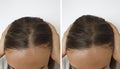 Woman baldness hair before  after treatment Royalty Free Stock Photo