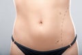Woman belly marked out for cosmetic surgery