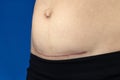 woman belly with a scar from a cesarean section close up Royalty Free Stock Photo