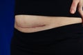 woman belly with a scar from a cesarean section close up Royalty Free Stock Photo