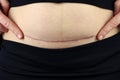 woman belly with a scar from a cesarean section close up Royalty Free Stock Photo