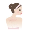 The woman with body acne vector illustration isolated on white background.