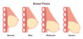 Woman breast ptosis. Stages of female breasts' sagging. Breast fat