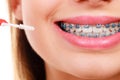 Woman brushing teeth with braces using brush Royalty Free Stock Photo