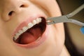 Woman with ceramic braces on teeth at the dental office