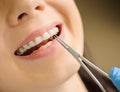 Woman with ceramic braces on teeth at the dental office Royalty Free Stock Photo