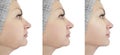 Woman chin lift before and after procedures