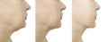 Woman chin before and after liposuction procedures Royalty Free Stock Photo