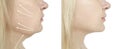 Woman chin, before and after problem tightening removal facelift