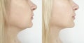Woman chin, before and after tightening removal facelift procedure