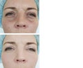 Woman circles skin correction therapy facial collage effect tension lifting before after antiaging