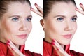Woman before and after cosmetic procedure