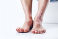 Woman cracked heels with white background, foot healthy concept Generative AI