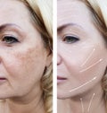 Woman wrinkles face patient crease pigmentation difference before and after procedures effect