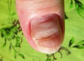 Woman hurting nail, Lithuania