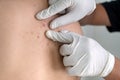 Woman Dermatologist examining birthmark of patient using medical