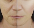 Woman difference wrinkles beautician pores results pigmentation face patient before and after lifting cosmetic procedures contrast Royalty Free Stock Photo