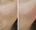 Woman difference wrinkles beautician results pigmentation face patient before and after lifting cosmetic procedures contrast