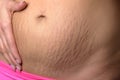 Woman displaying stretch marks after pregnancy Royalty Free Stock Photo