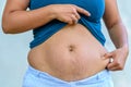 Woman displaying stretch marks after pregnancy Royalty Free Stock Photo