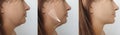 Woman double chin anti-aging plastic rejuvenation before and after treatment effect