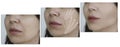 Woman double chin before  collage   effect   aesthetic  after treatment correction Royalty Free Stock Photo