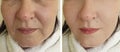 Woman double chin before and after collage facelift  effect treatment sagging problem Royalty Free Stock Photo