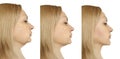 Woman double chin facelift before and after oval liposuction collage procedures Royalty Free Stock Photo