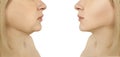 Woman double chin facelift tightening loss sagging before after problem oval liposuction collage procedures Royalty Free Stock Photo