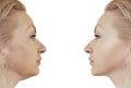 Woman double chin before and after procedures Royalty Free Stock Photo