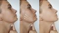 Woman double chin removal tightening  lifting  plastic saggy before and after treatment aesthetic Royalty Free Stock Photo